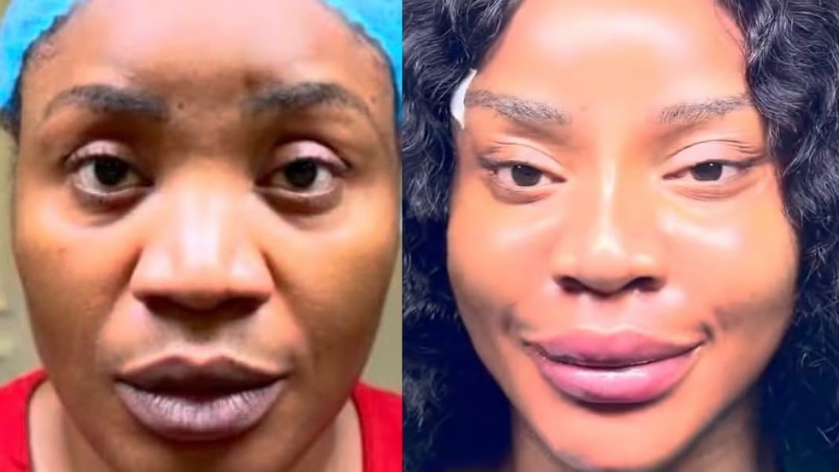 Uche - THEWILL NEWS MEDIA Split-screen close-up of a woman's face: left image shows a natural look, right image shows fuller lips and smoother skin after treatment (before/after).